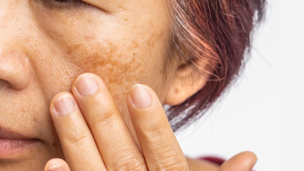 糖分の摂りすぎによって引き起こされた肌の「糖化（コゲつき）」。シミ、くすみ、色素沈着に悩む女性の肌のアップ。